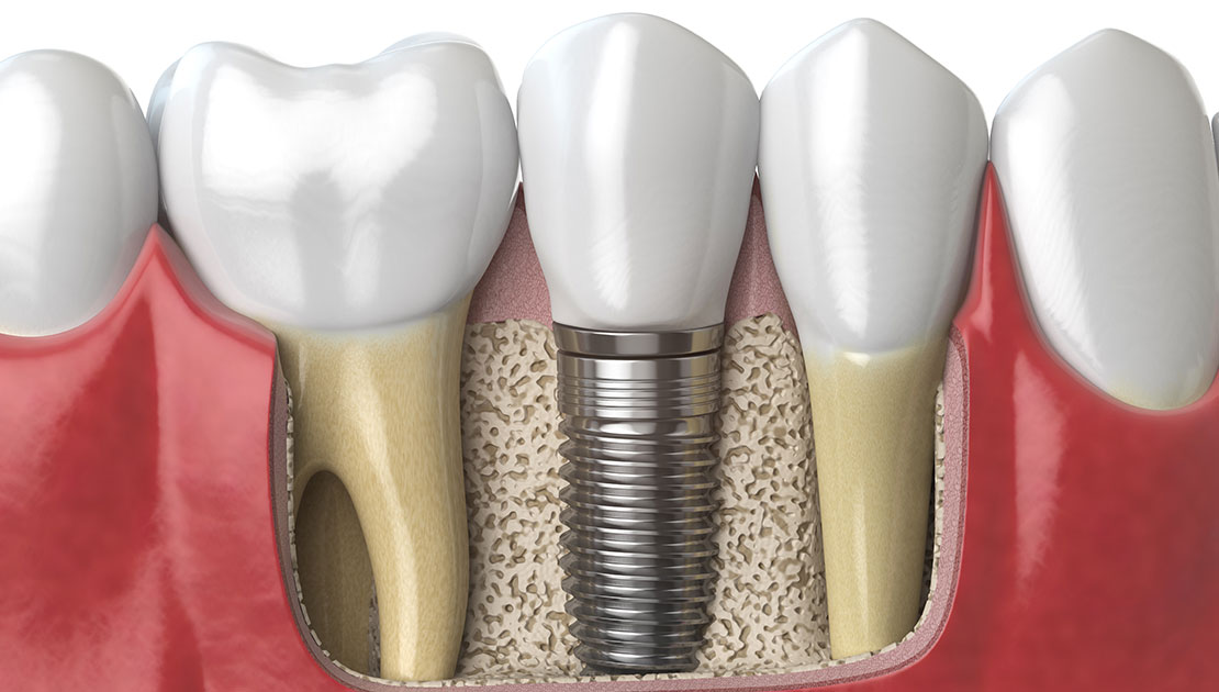 dental implant