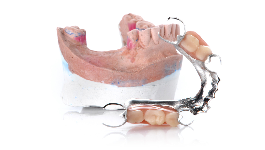 dental implant